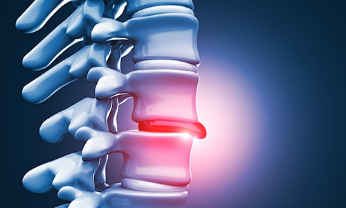 hilldt-herniated-disc.jpg